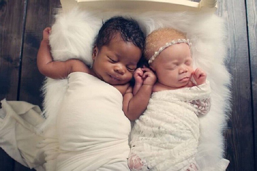 14 фото очаровательных близнецов с разным цветом кожи, ставших знаменитыми на весь мир