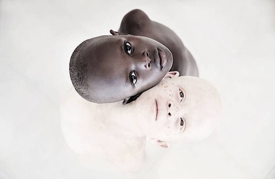 Потрясающие фото детей-альбиносов, призванные обратить внимание на ужасы их жизни