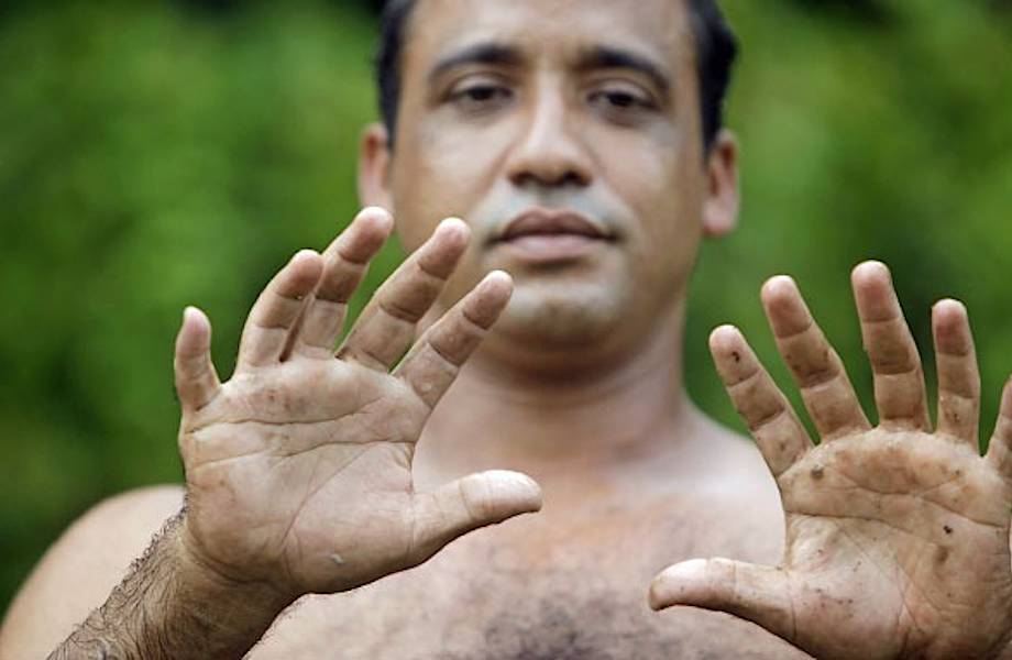 Невероятный человек: Эрнандес Гарридо, у которого по 6 пальцев на руках и ногах